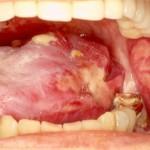 Consequences of mucositis