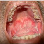 Consequences of mucositis